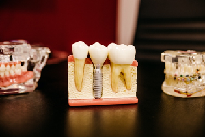 Anxiety & Teeth Grinding